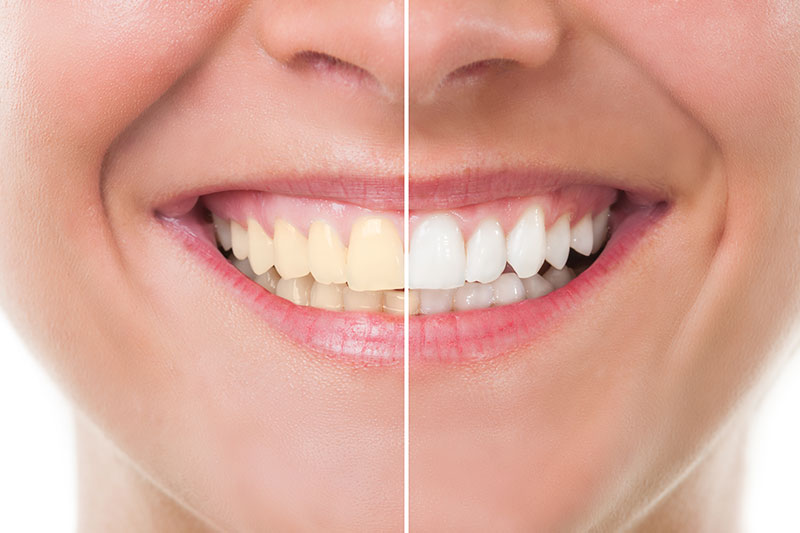 Teeth Whitening in Boulder City